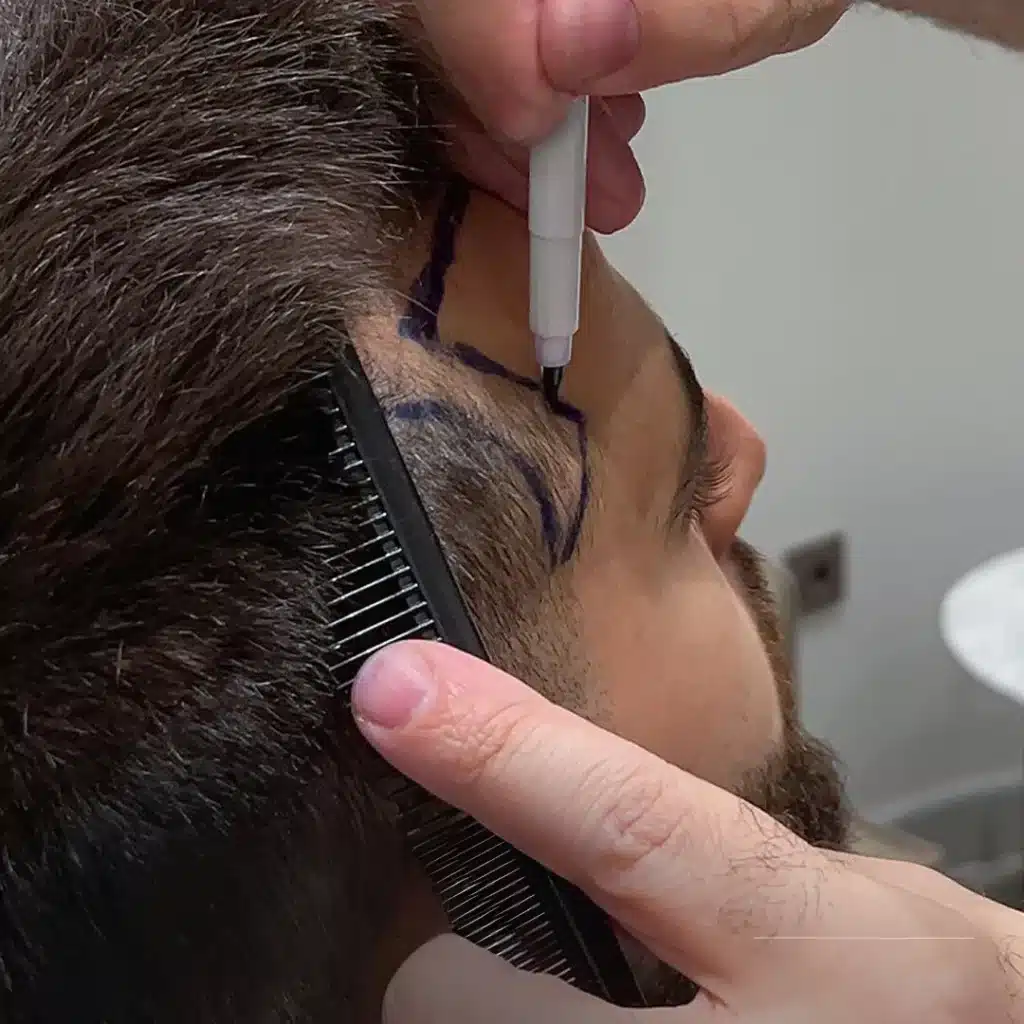 Hair Transplant
